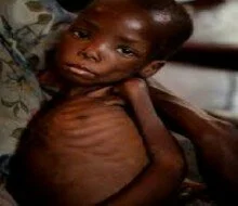 Unicef – 400,000 Children Under-Five Threatened By Severe Malnutrition