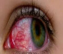 Arthritis drug may help treat rare eye disease
