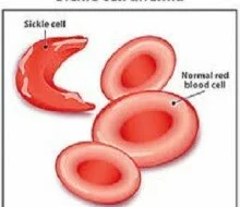Nigeria: Company Creates Awareness on Sickle Cell Anemia
