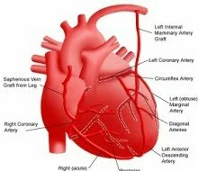 Coronary artery surgery can prevent heart failure in people with diabetes!