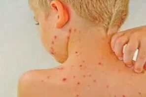 Facts on Chicken Pox.