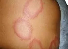 How to prevent ringworm infection